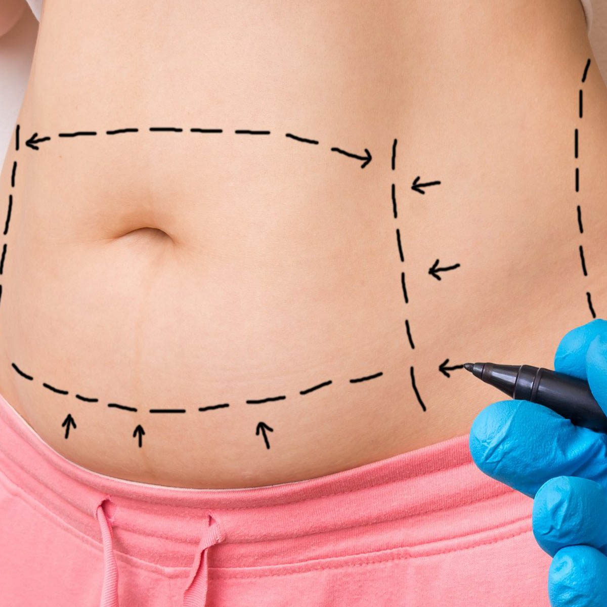 Abdominoplastía 1