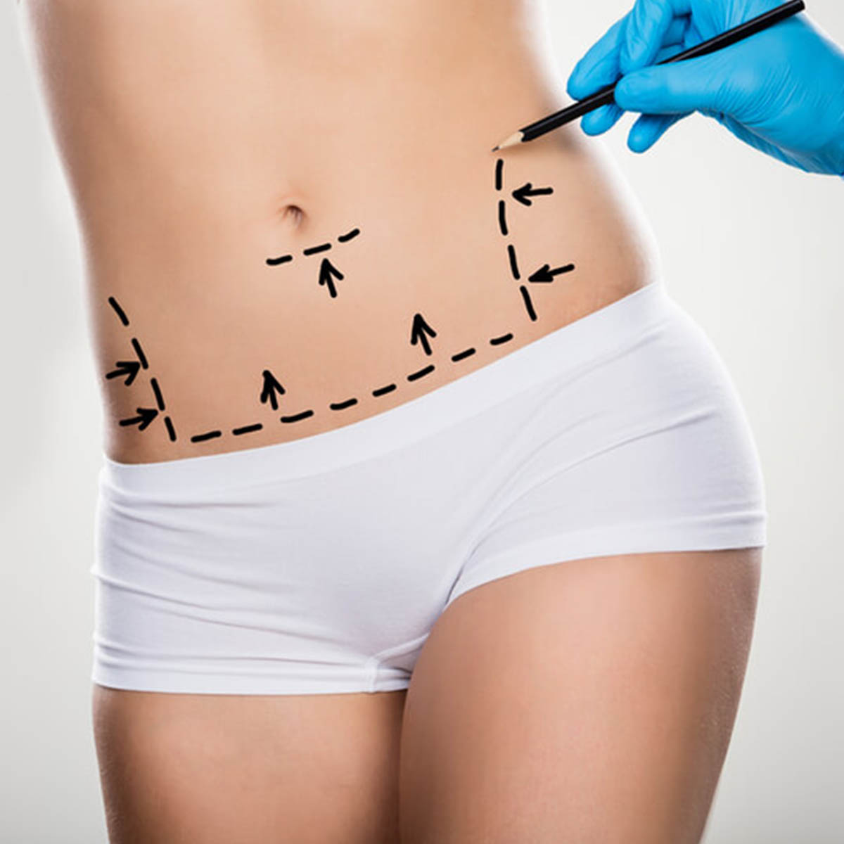Abdominoplastía 2