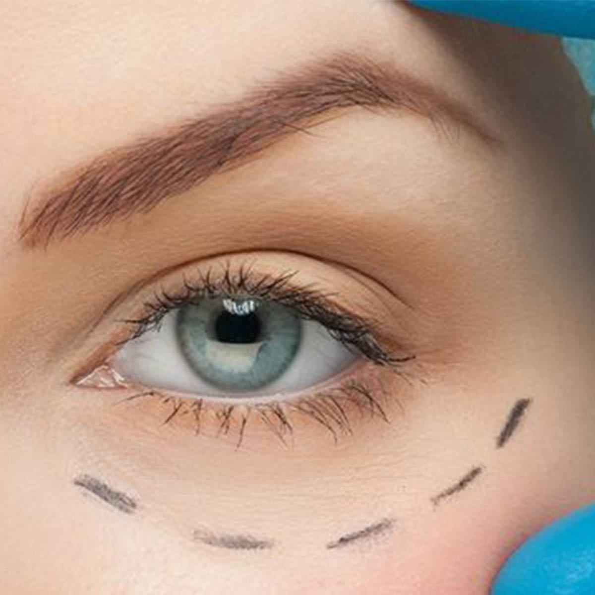 Blefaroplastia 2