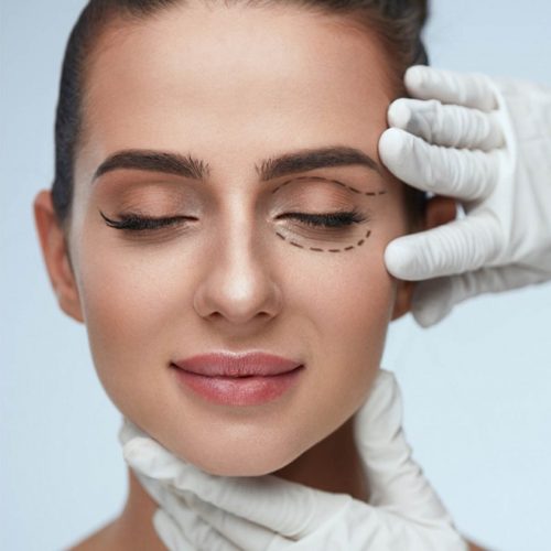 Blefaroplastia 3 Blefaroplastia 3