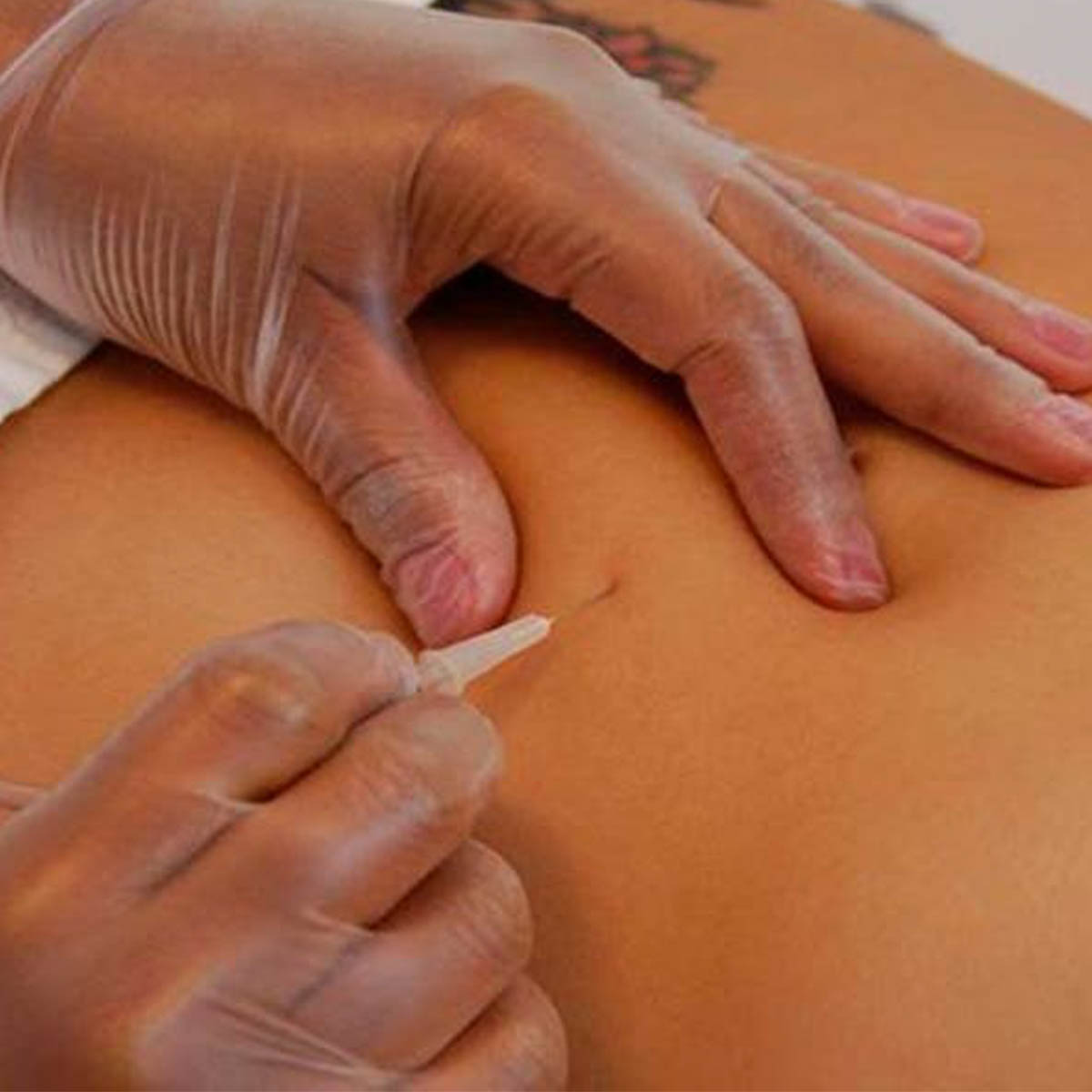 Carboxiterapia
