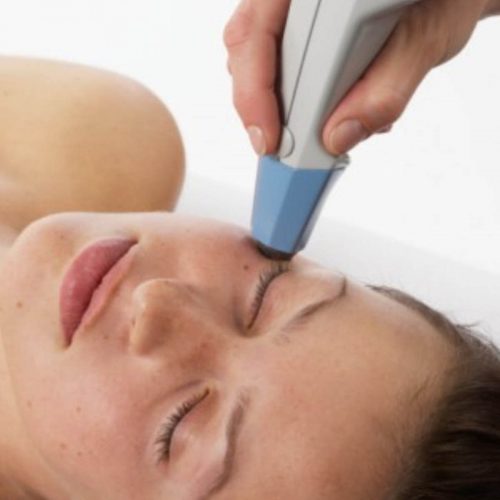 Exilis Facial Exilis Facial