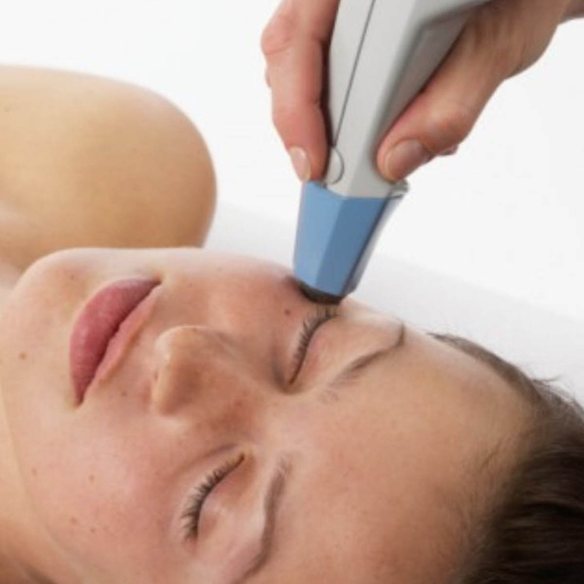 Exilis Facial