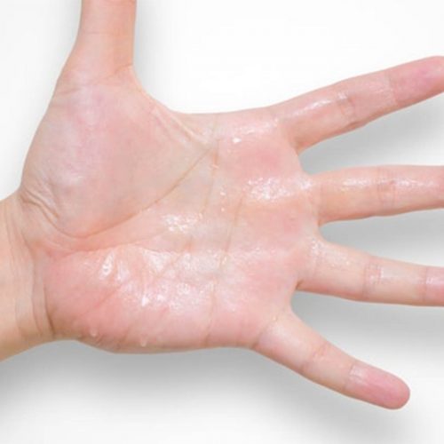 Hiperhidrosis