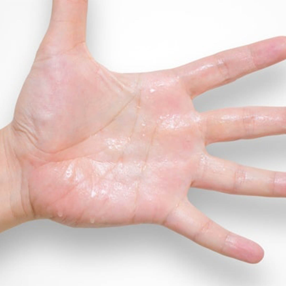Hiperhidrosis