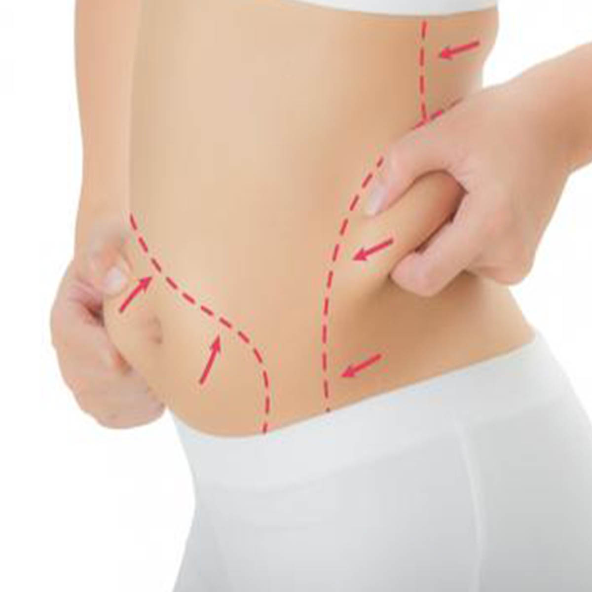 Lipoescultura 1