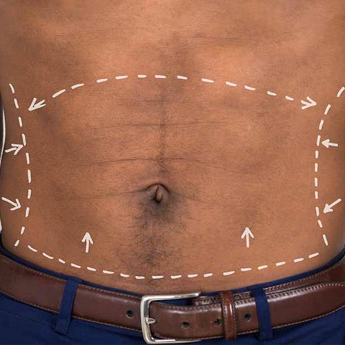 Marcaje Abdominal 1 Marcaje Abdominal 1