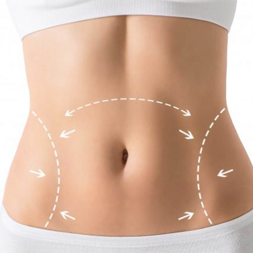 Marcaje Abdominal 2 Marcaje Abdominal 2