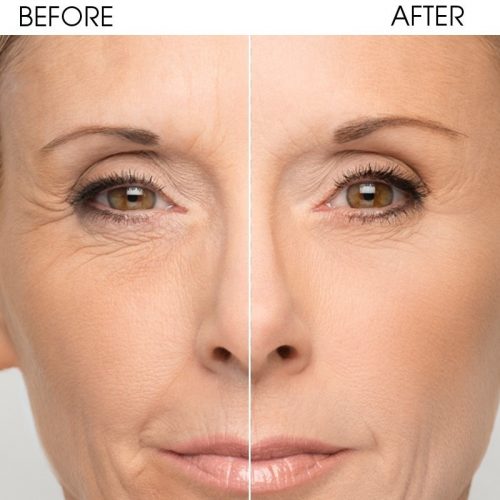 Relleno Facial